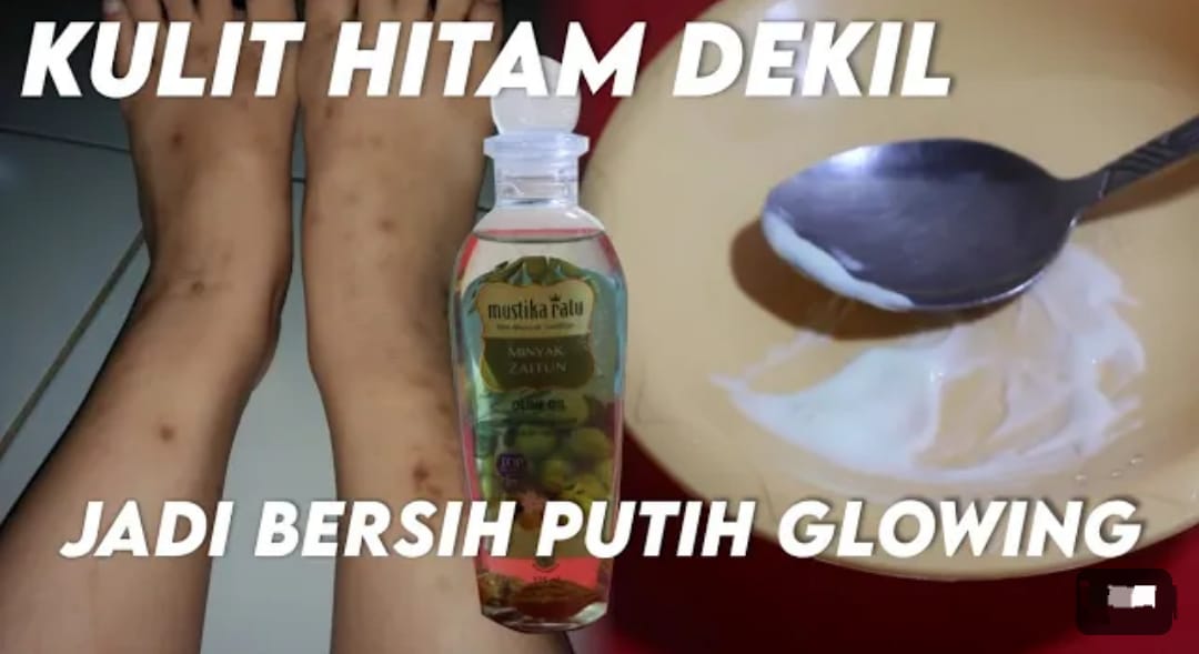 3 Cara Menghilangkan Bekas Luka Lama yang Menghitam Dengan Bahan Dapur, Kulit Bebas Koreng dan Putih Permanen