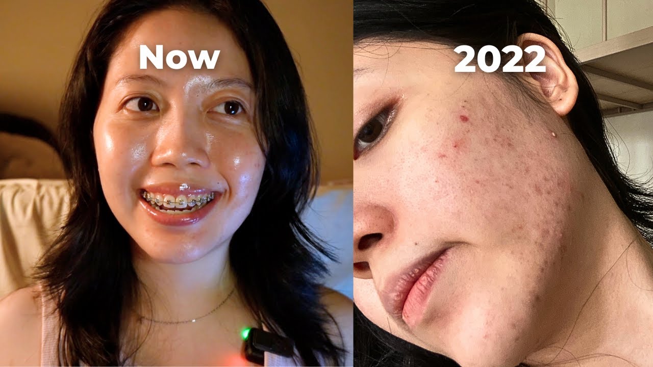 4 Cara Mudah Menghilangkan Flek Hitam dan Sel Kulit Mati Cuma Pakai Bahan Alami