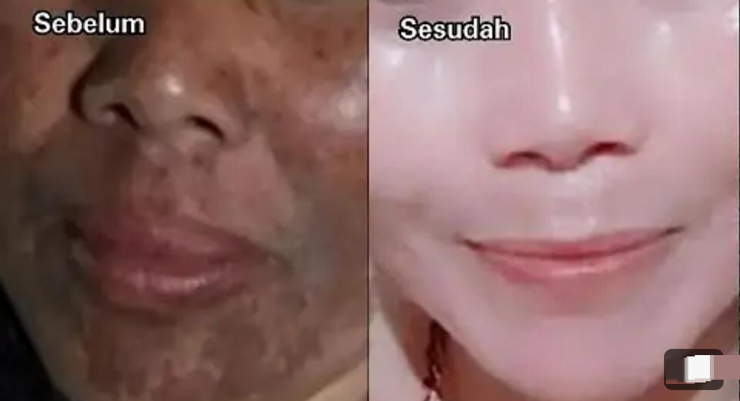 3 Masker Alami untuk Menghilangkan Flek Hitam Permanen, Lengkap Cara Membuatnya Agar Wajah Kencang Bebas Kusam