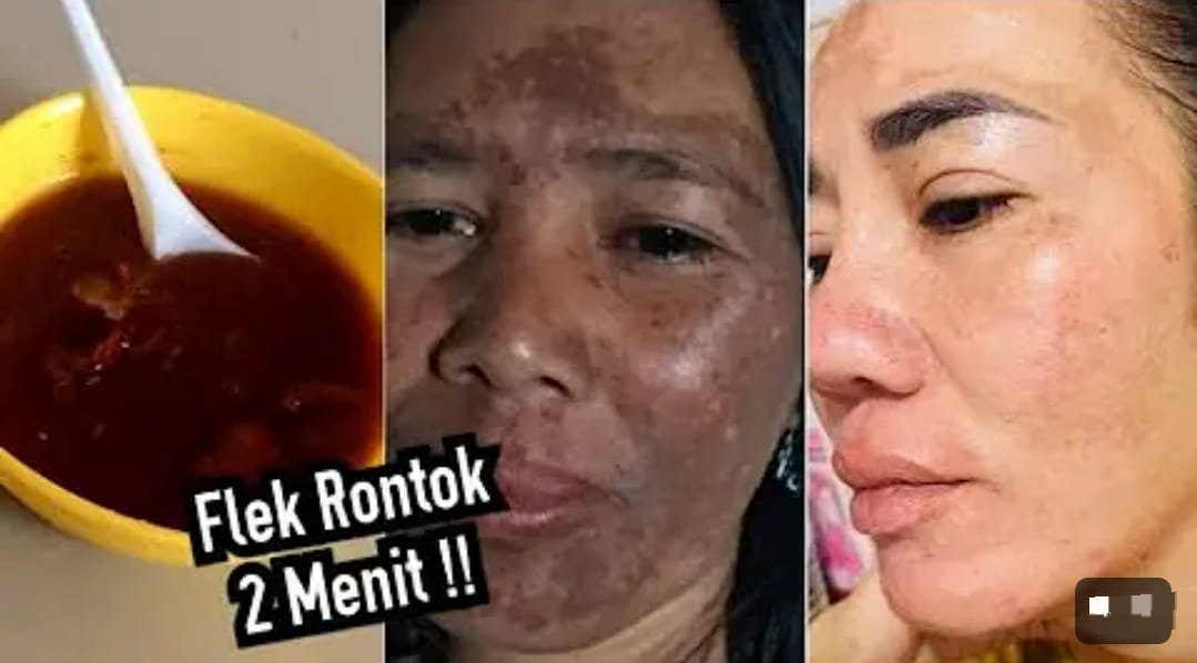 Begini Cara Meracik Masker untuk Flek Hitam Secara Alami Pakai Bahan Dapur, Cuma 3 Langkah Kulit Awet Muda