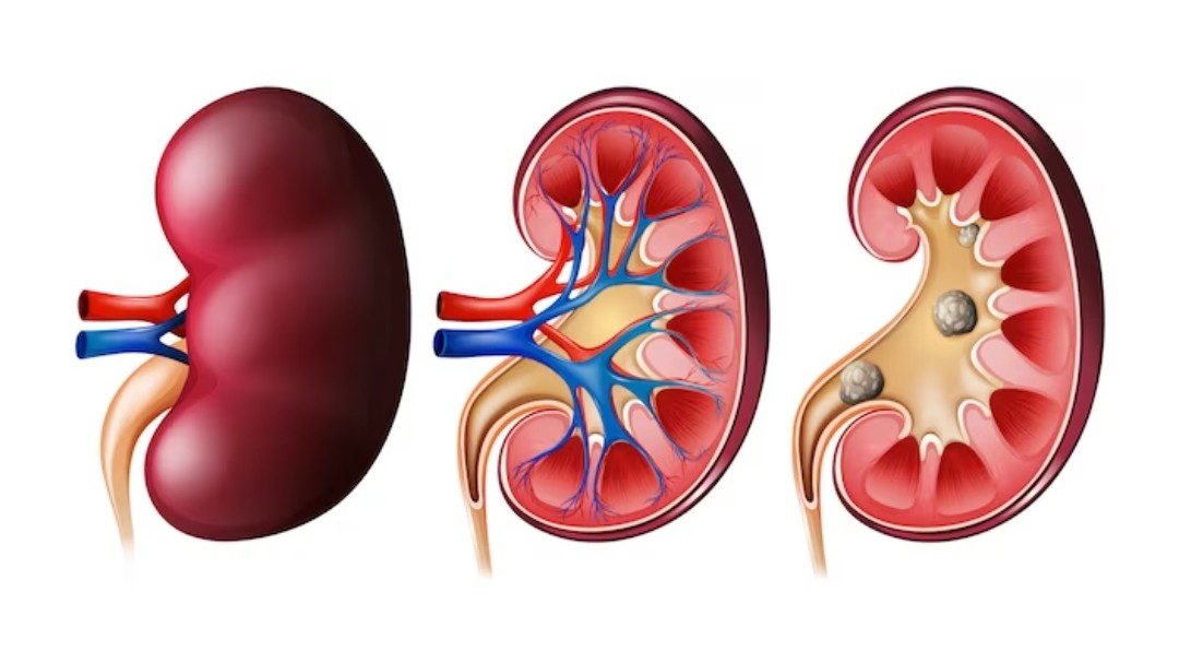 Inilah 5 Pertanda Kalau Organ Ginjal Terganggu Fungsinya, Yuk Segera Periksakan!