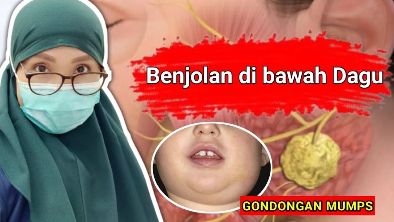 Ciri-Ciri Orang Mengalami Gondongan Mulai Dari Awal Hingga Lebih Serius pada Anak Umur 5-10 Tahun!