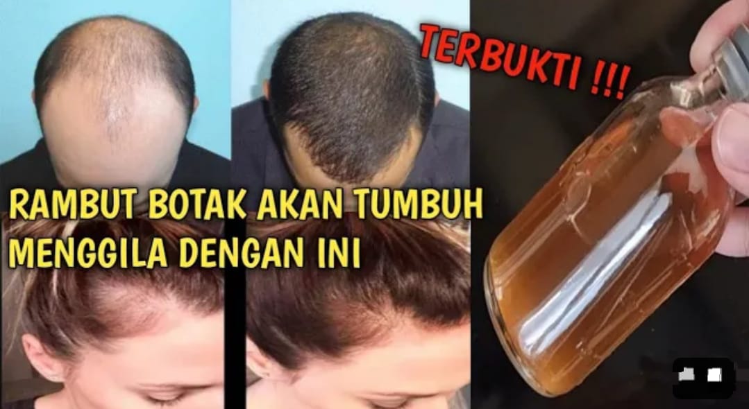 4 Cara Menumbuhkan Rambut yang Botak Secara Alami dan Cepat, Cocok untuk Menghilangkan Uban Secara Permanen