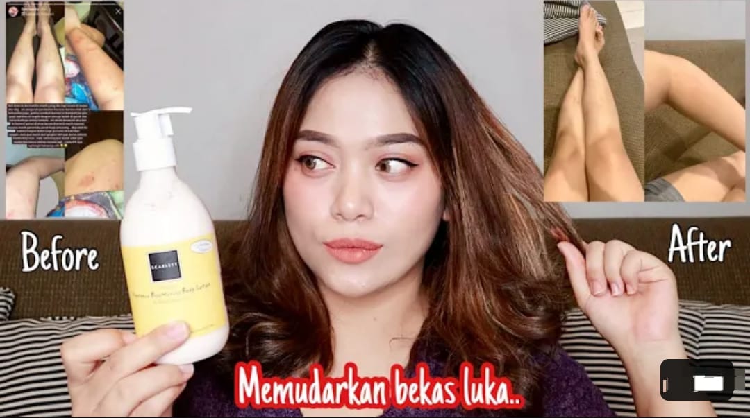 3 Merk Handbody Penghilang Bekas Luka Hitam Dengan Cepat, Kulit jadi Putih Kencang dan Mulus Permanen