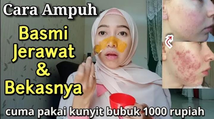 Ternyata 5 Bahan Dapur yang Ampuh Mengatasi Jerawat Ini Bikin Kulit Mulus Cantik Alami, Begini Cara Pakainya