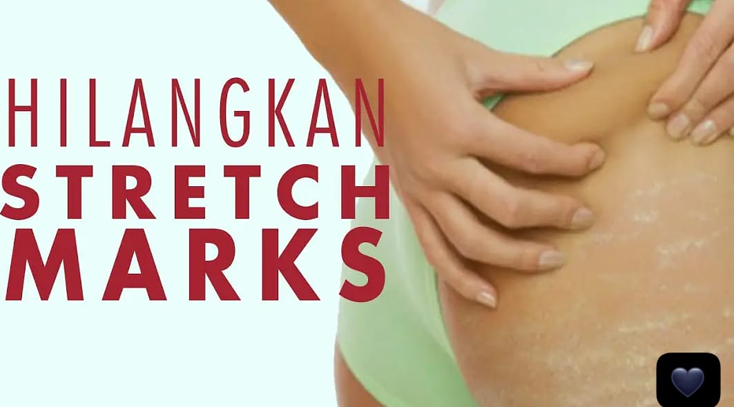 4 Cara Menghilangkan Stretch Mark Dengan Bahan Dapur Agar Mulus Permanen