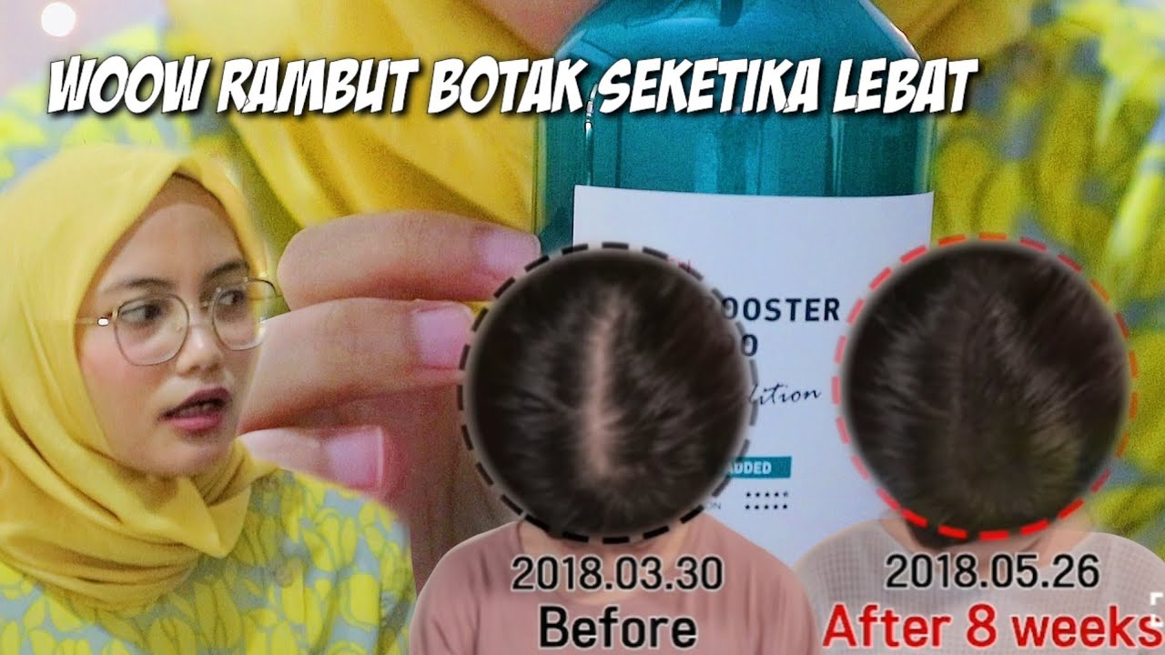 4 Shampo Penumbuh Rambut Botak Paling Ampuh, Rambut Jadi Lebat dan Sehat Modal 20 Ribuan di Indomaret