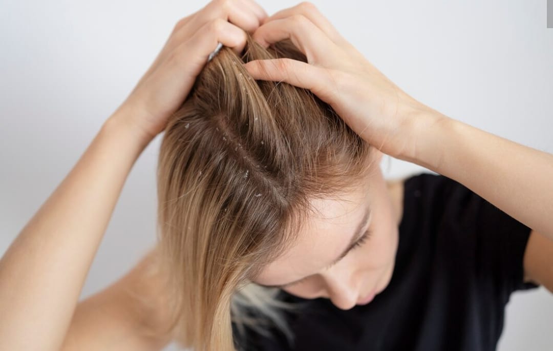 4 Cara Mengatasi Rambut Rontok Parah Hampir Botak Secara Alami