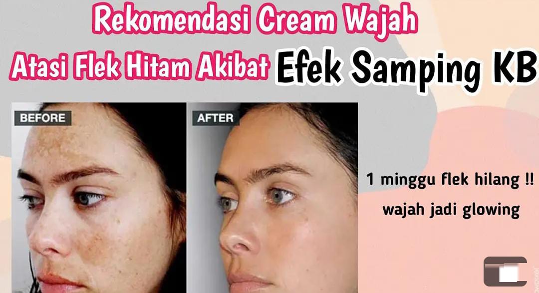 3 Krim yang Bisa Menghilangkan Flek Hitam Agar Wajah Glowing, Cocok Untuk Hilangkan Kerutan di Wajah!