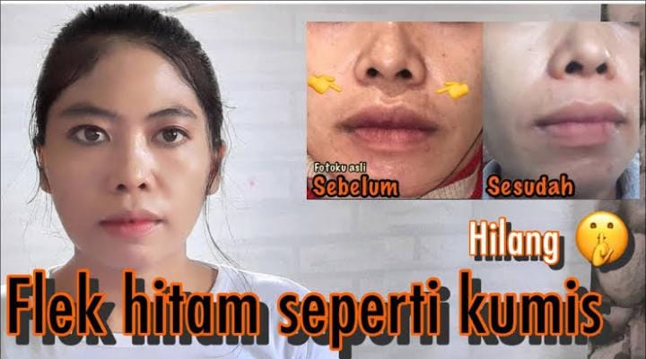 Inilah 5 Krim yang Memutihkan Flek Hitam dengan Cepat, Bikin Kulit Cerah Merata Bonus Awet Muda