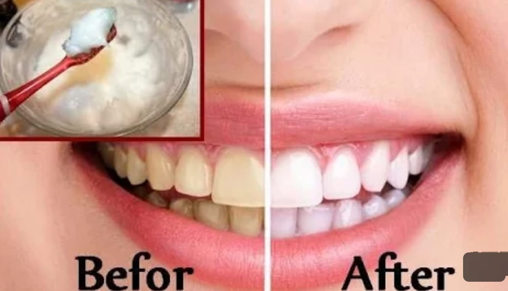 3 Cara Memutihkan Gigi Kuning dan Berkerak Dalam 1 Malam, Pakai Bahan Dapur Gigi Putih Bebas Bau Mulut