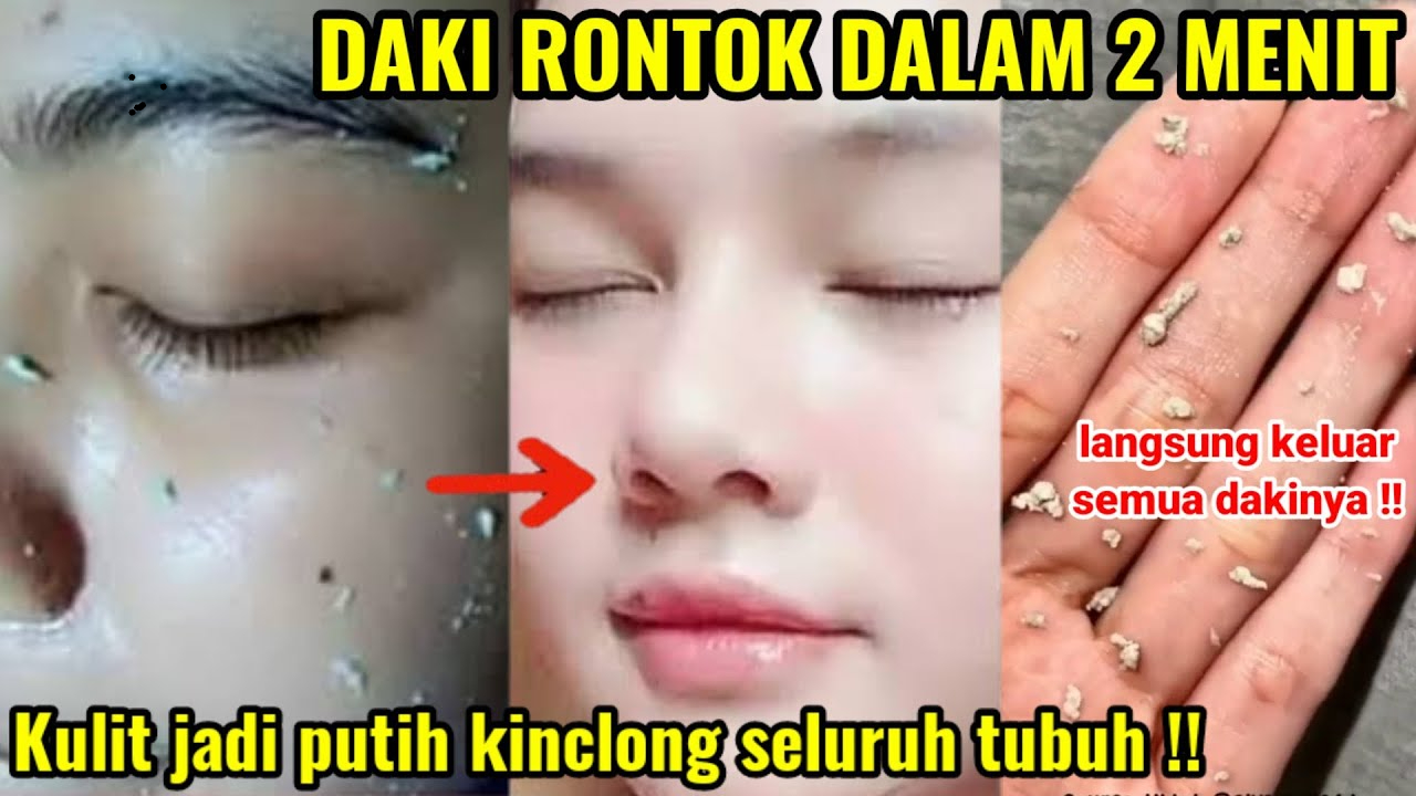 3 Cara Mengelupas Flek Hitam dengan Masker Alami, Efektif Samarkan Pori-Pori Terbuka