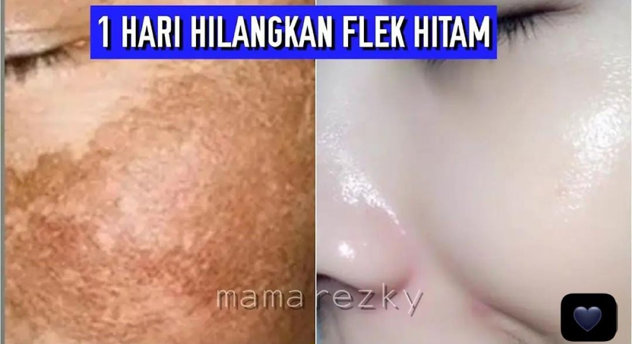 3 Bahan Alami yang Dapat Mengelupas Flek Hitam Dalam 1 Malam, Kulit Auto Glowing!