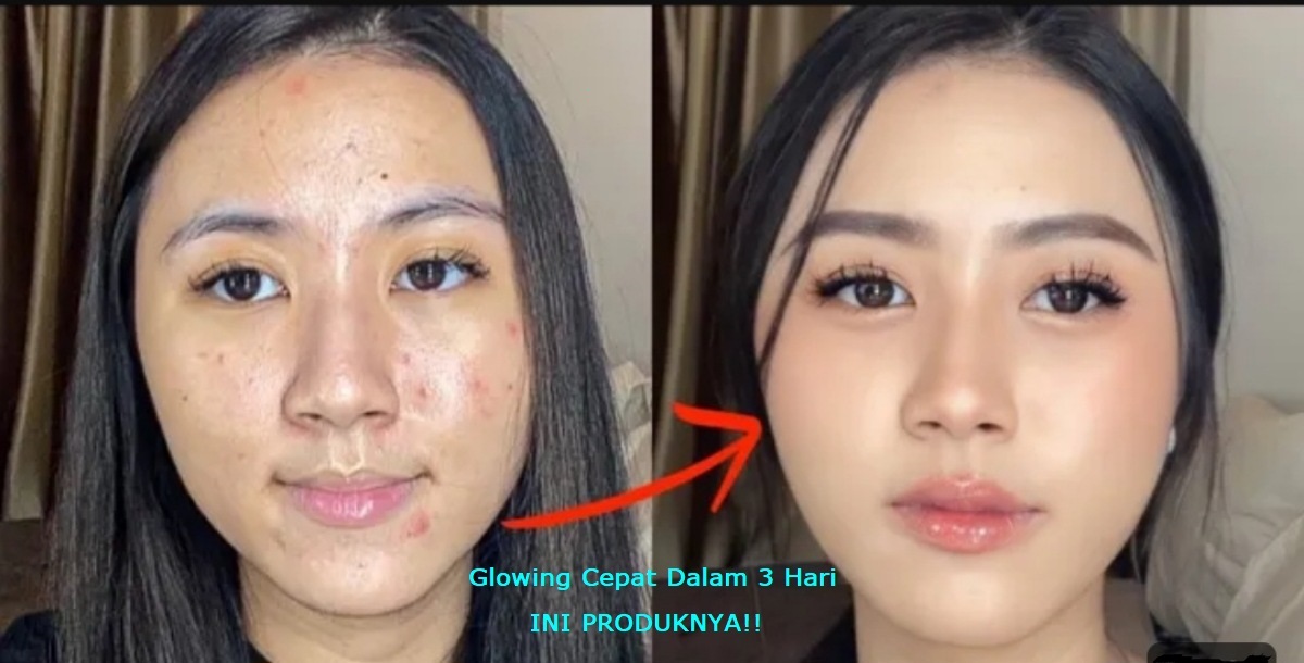 Murah! Ini 3 Bedak Acne yang Cocok untuk Kulit Berjerawat dan Berminyak, Bikin Wajah Glowing Bebas Noda