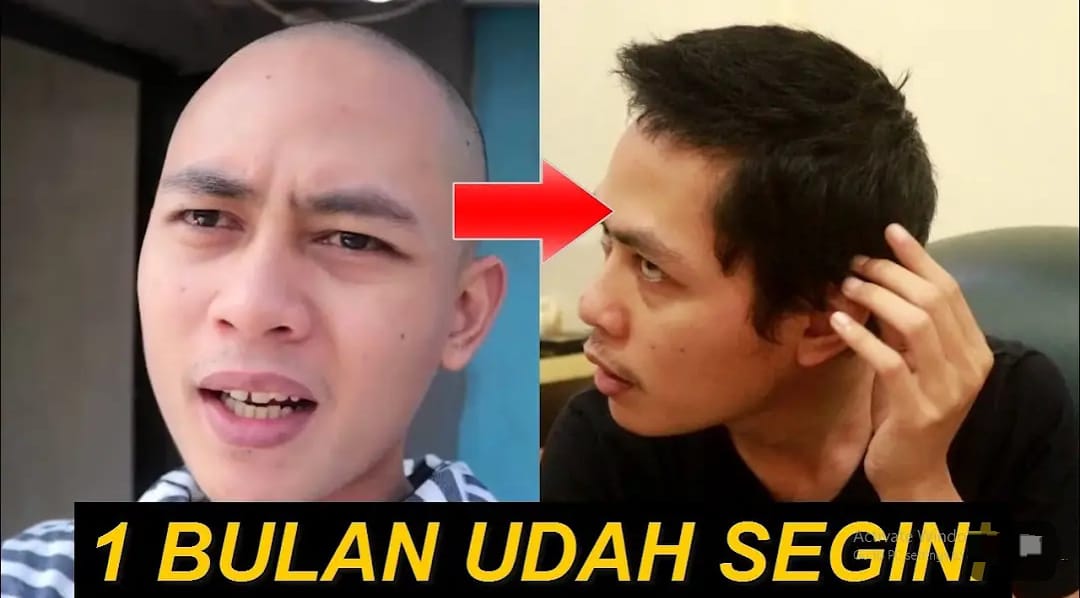 Pusing Rambut Botak dan Tipis? Ini 4 Cara Numbuhin Rambut Cepat Alami Cuma Pakai 1 Bahan Rambut Hitam Permanen