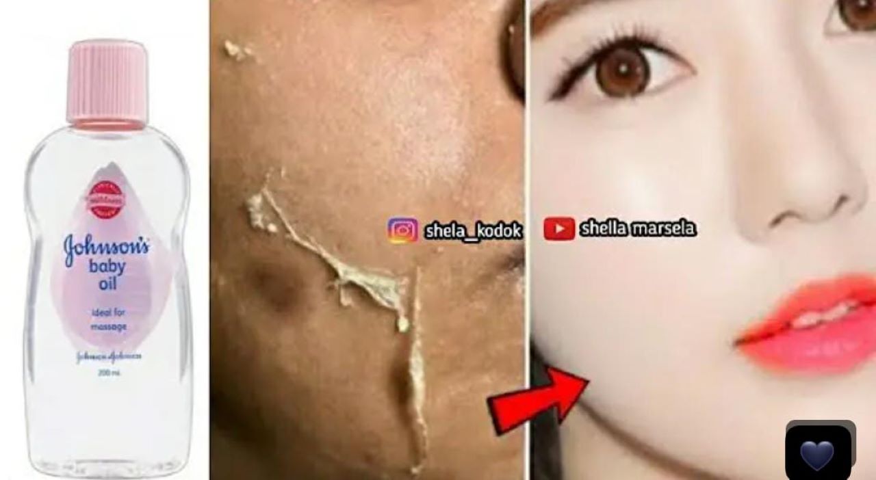 3 Cara Pakai Baby Oil untuk Mengelupas Flek Hitam Tanpa Bekas, Wajah Langsung Glowing Dalam 1 Malam