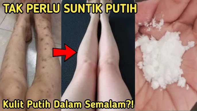 Begini Cara Membuat Lulur Pemutih Badan Permanen dari Beras, Bekas Koreng Hitam Langsung Hilang!