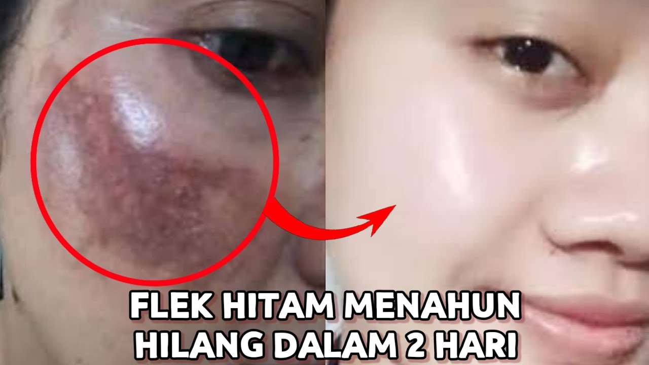 Tips Alami Memutihkan Flek Hitam Menahun, Cuma Pakai 4 Bahan Dapur Bikin Wajah Mulus dan Bersih