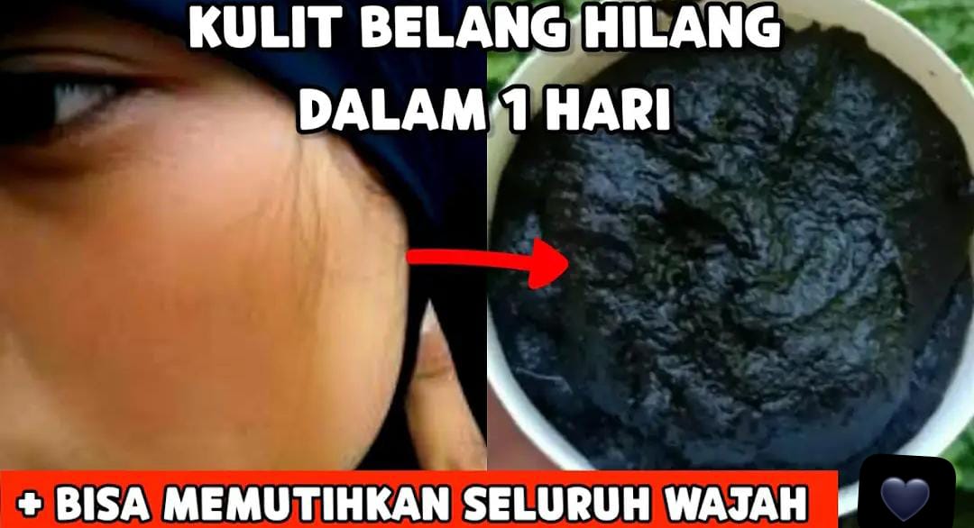 3 Cara Menghilangkan Belang di Wajah Dengan Cepat, Kulit Langsung Glowing!