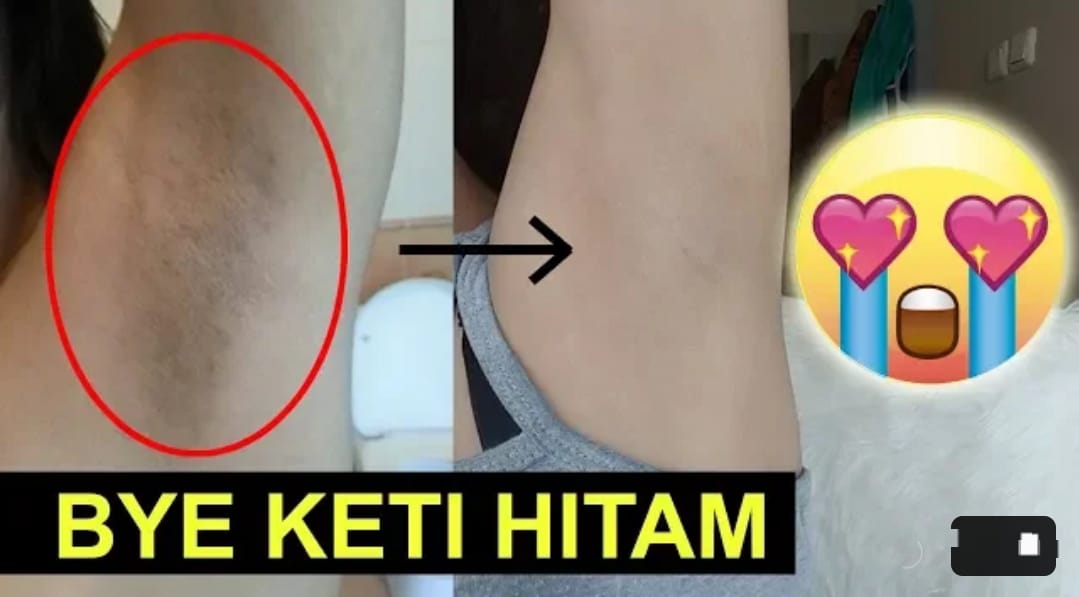 3 Cara Gampang Memutihkan Ketiak Hitam dengan Bahan Alami Dalam Semalam, Ampuh Hilangkan Bau Badan Permanen