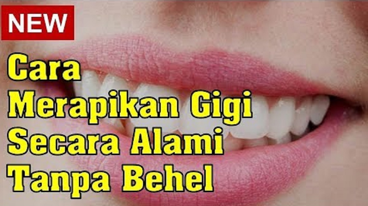 5 Cara Cepat Merapikan Gigi Tanpa Behel dalam 1 Hari, Bikin Gigi Tampil Putih Bersih Rata Gak Berantakan 