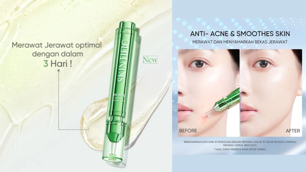 NEW LAUNCH! Review Skintific 3X Acid Intensive Acne Spot, Bikin Wajah Mulus Lagi