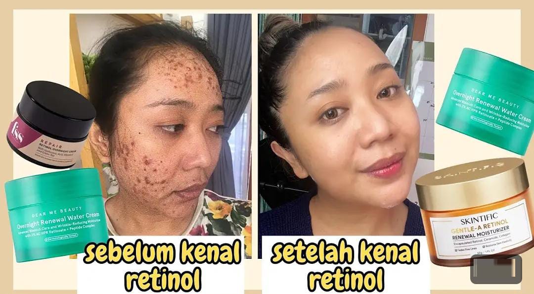 4 Skincare yang Mengandung Retinol untuk Wajah Glowing Awet Muda, Ampuh Hilangkan Flek Hitam di Wajah!