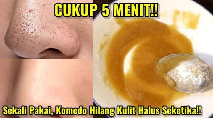 4 Cara Mudah Menghilangkan Komedo dengan Bahan Alami, Bonus Kulit Cerah dan Mulus Merata