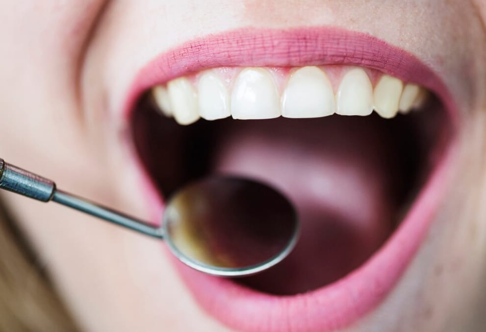 6 Bahan Alami Penghilang Karang Gigi dan Pemutih Alami untuk Senyum Lebih Cerah