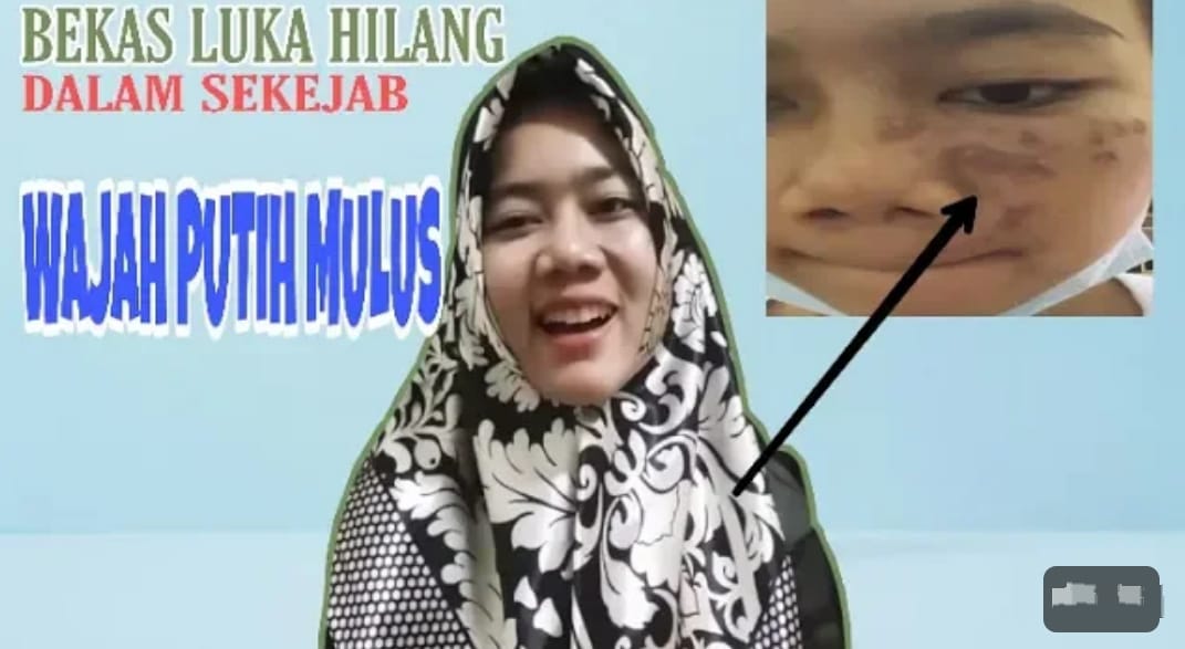 3 Cara menghilangkan Bekas Luka di Wajah Dengan Cepat Menggunakan Bahan Dapur, Kulit Glowing Bebas Flek Hitam