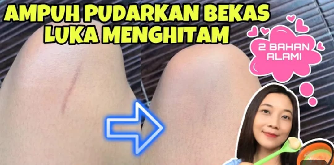 3 Bahan Dapur Penghilang Bekas Luka Menghitam di Kaki Dalam 1 Malam, Kulit Putih Kenyal Bebas Bekas Koreng