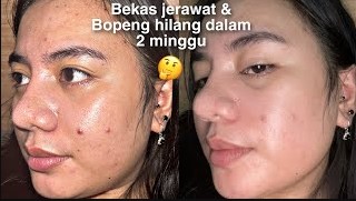 4 Skincare Penghilang Bopeng dan Noda Hitam, Bikin Wajah Glowing Mulus dengan Cepat