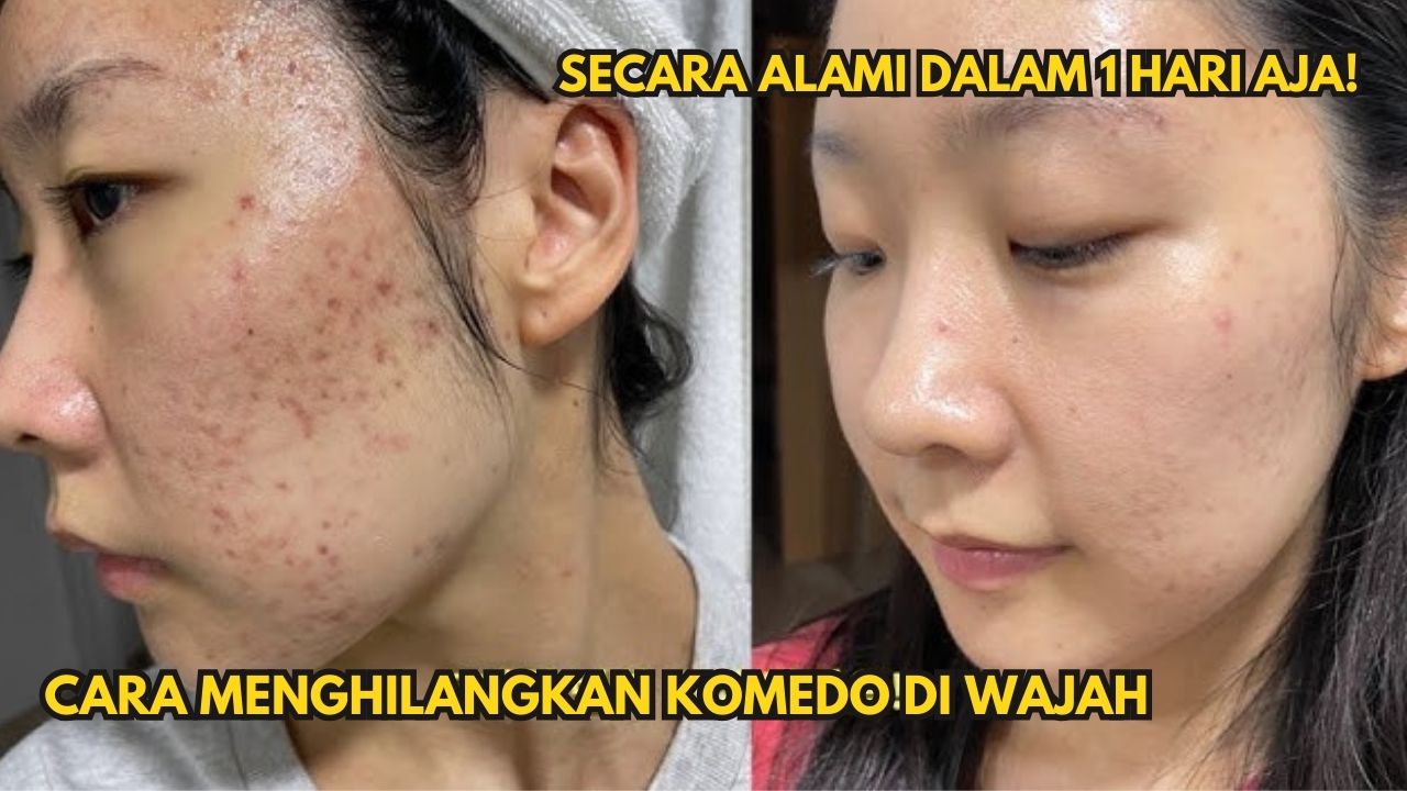Begini Cara Menghilangkan Komedo Secara Alami dalam 1 Hari Tanpa Skincare