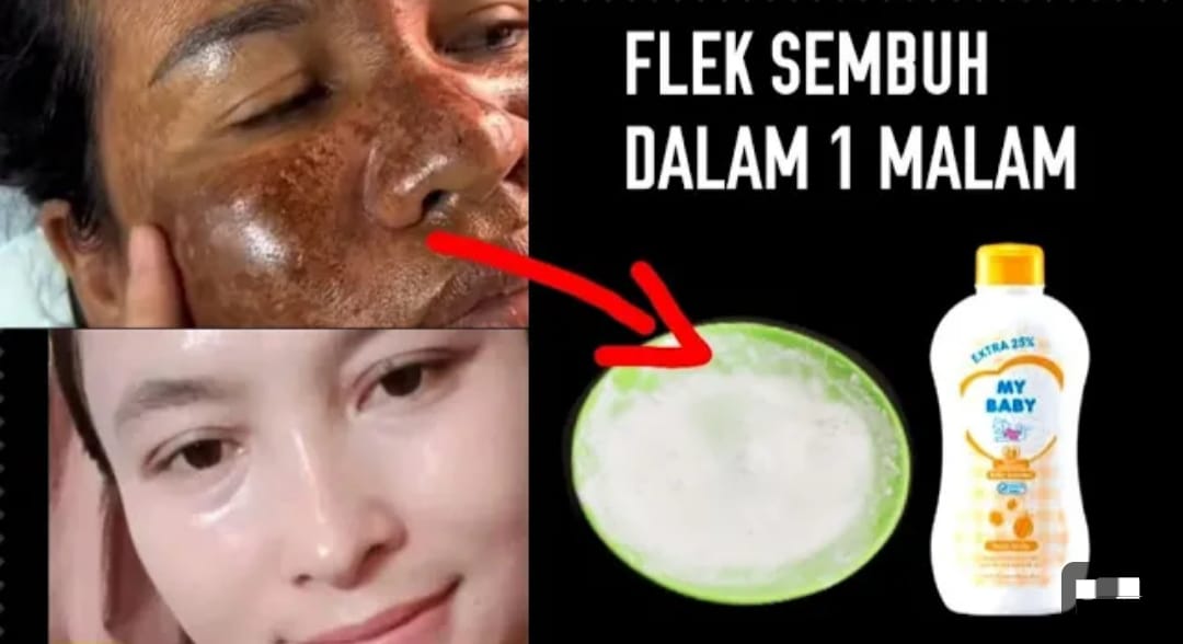 4 Cara Membuat Masker Menghilangkan Flek Hitam Secara Permanen, Wajah Langsung Mulus Bebas Noda dan Kusam