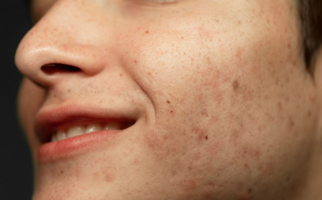 Cara Menyamarkan Tampilan Pori-Pori dalam 4 Langkah, Bukan Putih Telur