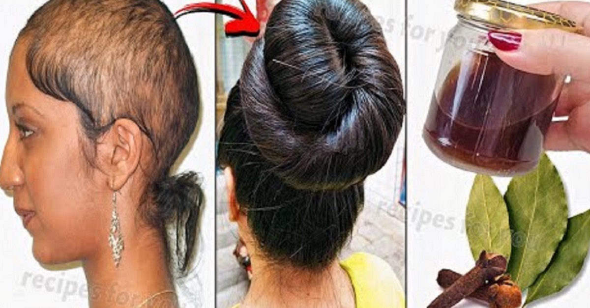 Cara Menebalkan Rambut Botak dengan Bahan Dapur, Rambut Botak Hilang dalam 3 Hari