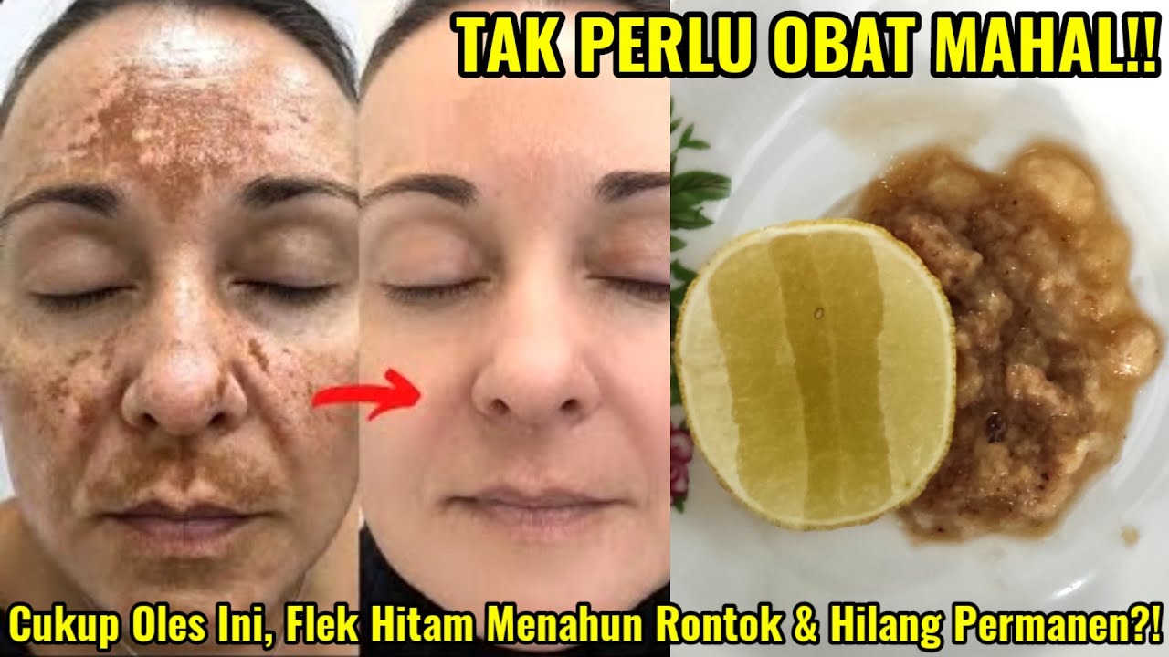 3 Cara Menghilangkan Flek Hitam di Wajah Secara Alami, Cuma Pakai Bahan di Dapur Kulit Jadi Glowing Awet Muda