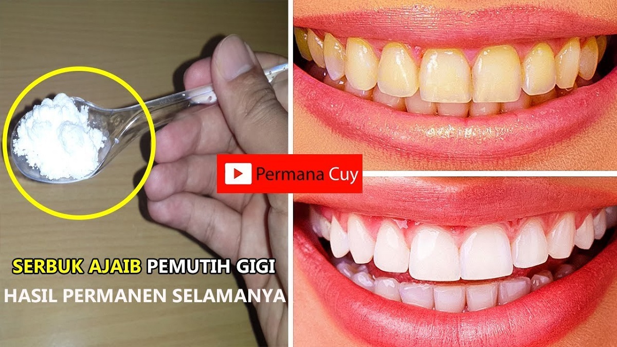 4 Cara Jitu Merontokkan Karang Gigi yang Sudah Mengeras Pakai Baking Soda, Gigi Putih Tanpa Karang Membandel