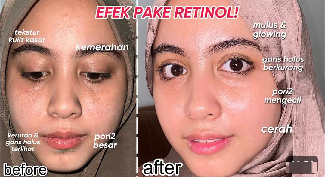 3 Serum Retinol Murah dan Bagus untuk Wajah Glowing, Cocok Untuk Usia 40 Tahun Ke Atas Agar Kencang Awet Muda