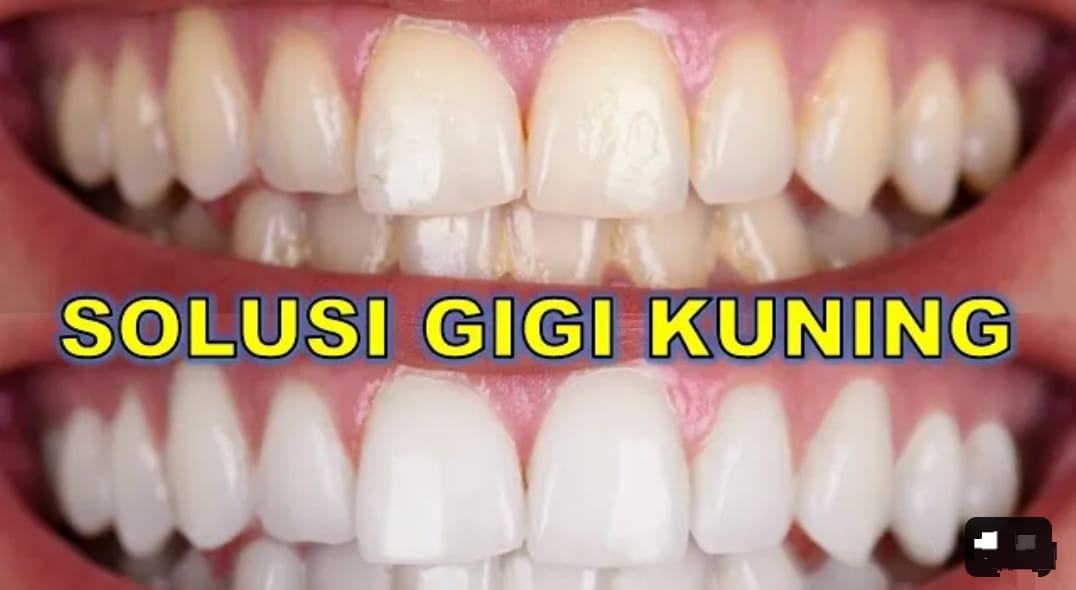 3 Cara Instan Memutihkan Gigi Kuning Secara Alami Dengan Bahan Dapur, Ampuh Hilangkan Karang Gigi Mengeras