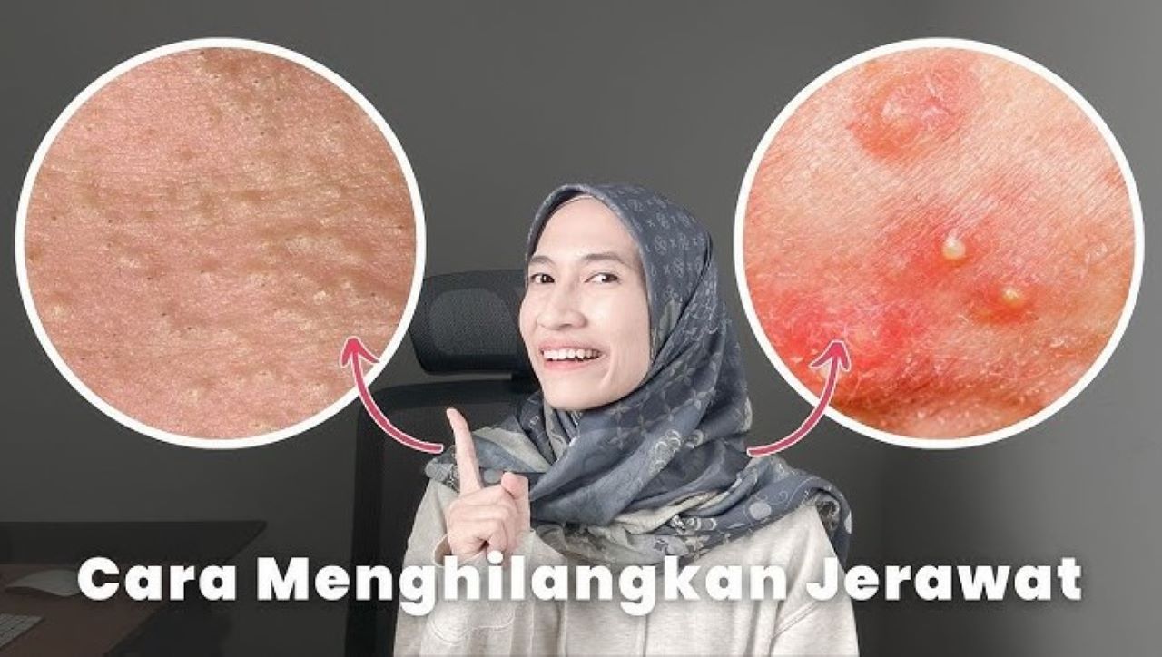 8 Cara Simpel Merawat Kulit Agar Tidak Mudah Jerawatan, Nggak Asal Pakai Skincare