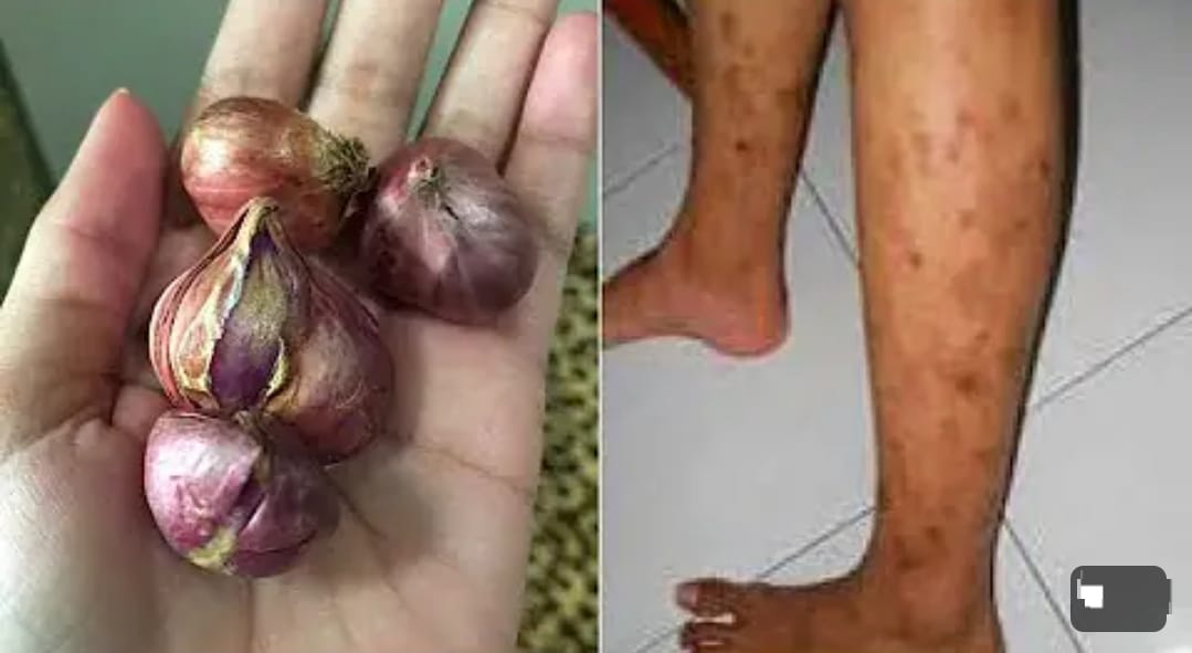 4 Cara Menghilangkan Bekas Luka Bakar yang Menghitam di Kaki Dalam 1 Malam, Kulit Langsung Mulus dan Cerah