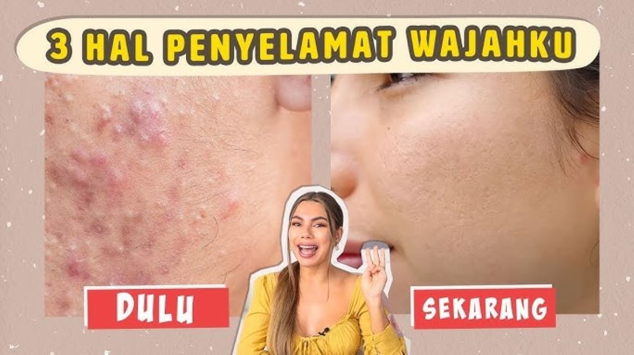 DIY Masker Pemudar Bekas Jerawat, Bikin Kulit Cerah Merata dengan 3 Bahan Alami 
