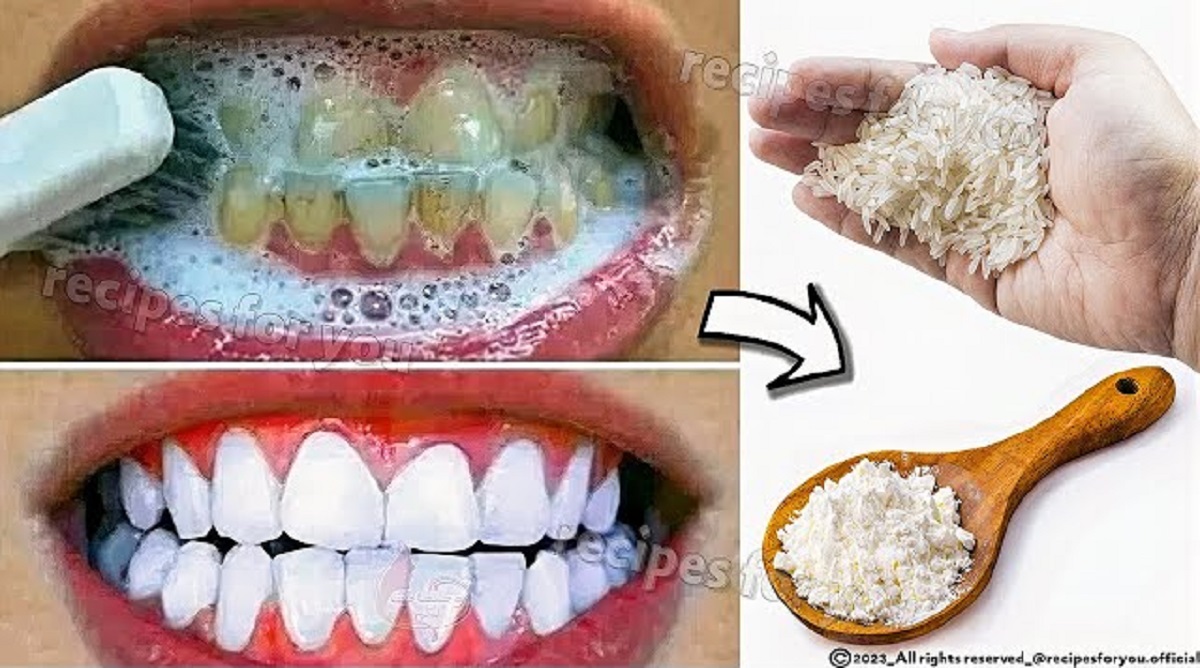 4 Cara Alami Yang Ampuh Untuk Membersihkan Karang Gigi Yang Membandel, Efektif Gigi Bersih Tanpa Plak Lagi