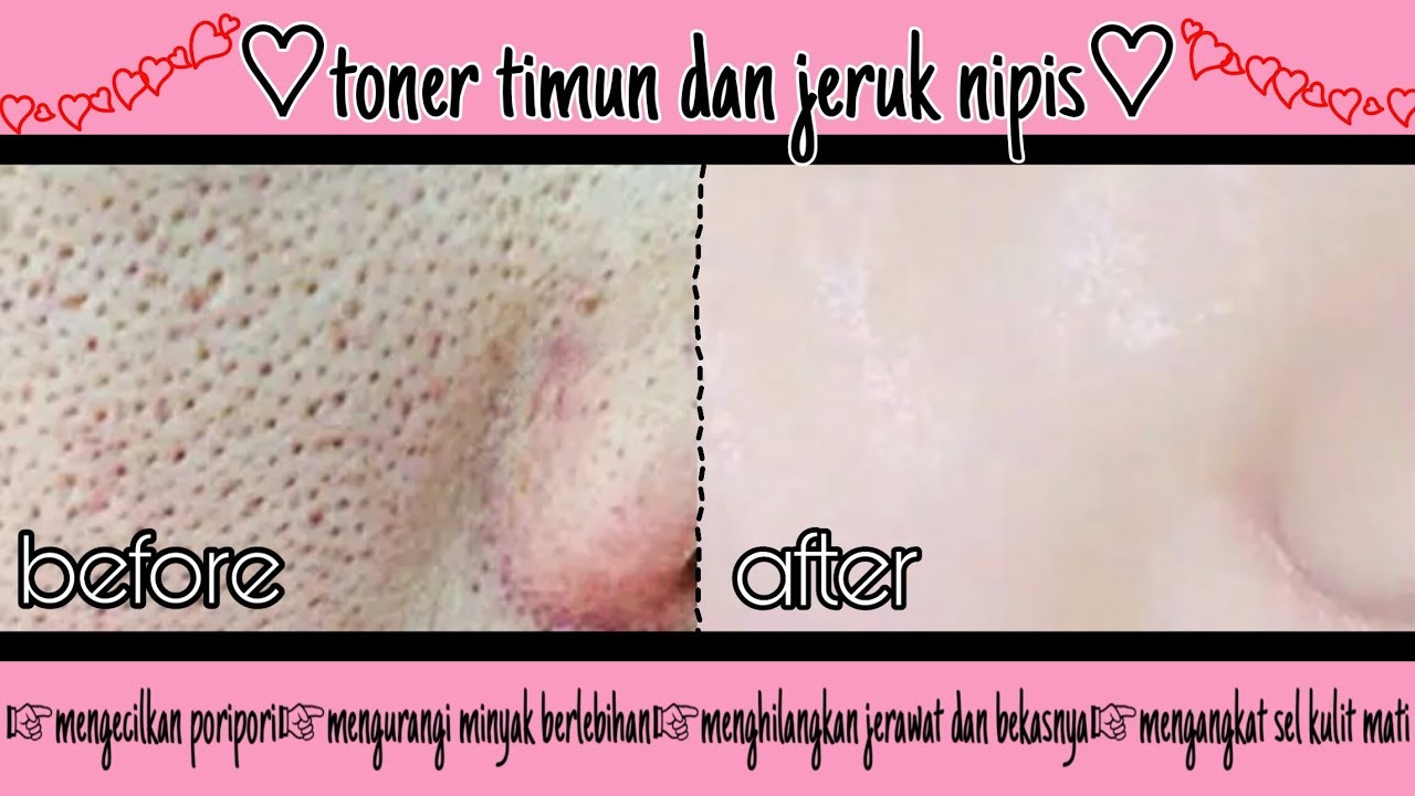 3 Cara Membuat Toner Alami untuk Mengecilkan Pori-Pori Agar Glowing dan Mulus