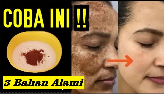 Ini Cara Cepat Menghilangkan Flek Hitam di Wajah dalam 1 Malam, 3 Bahan Ini Ampuh Glowingkan Wajah Bebas Noda