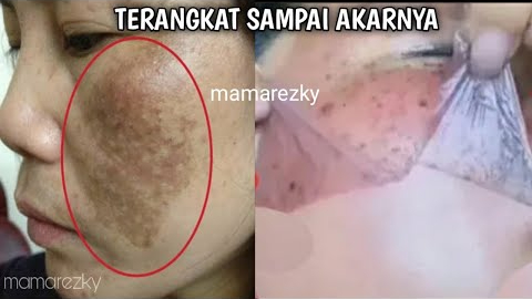 2 Cara Gampang Menghilangkan Flek Hitam dengan Kunyit, Modal 1 Bahan Bikin Glowing Tanpa Pakai Skincare