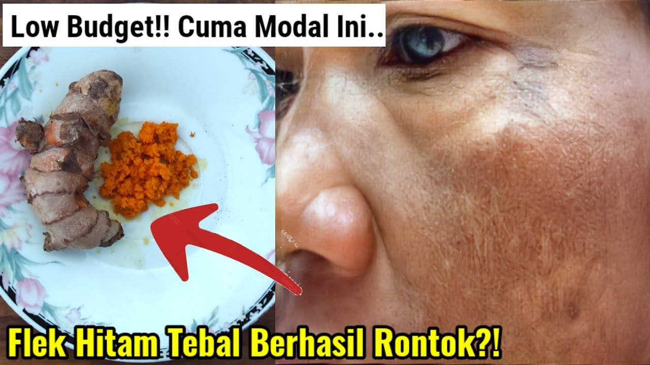 Begini Cara Mengelupas Flek Hitam dengan Minyak dalam 1 Malam