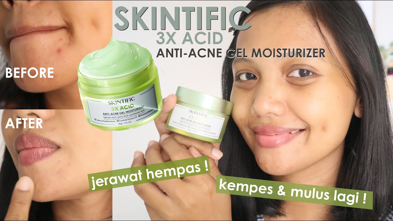 Review Moisturizer Skintific 3X Acid untuk Kulit Berjerawat dan Bruntusan