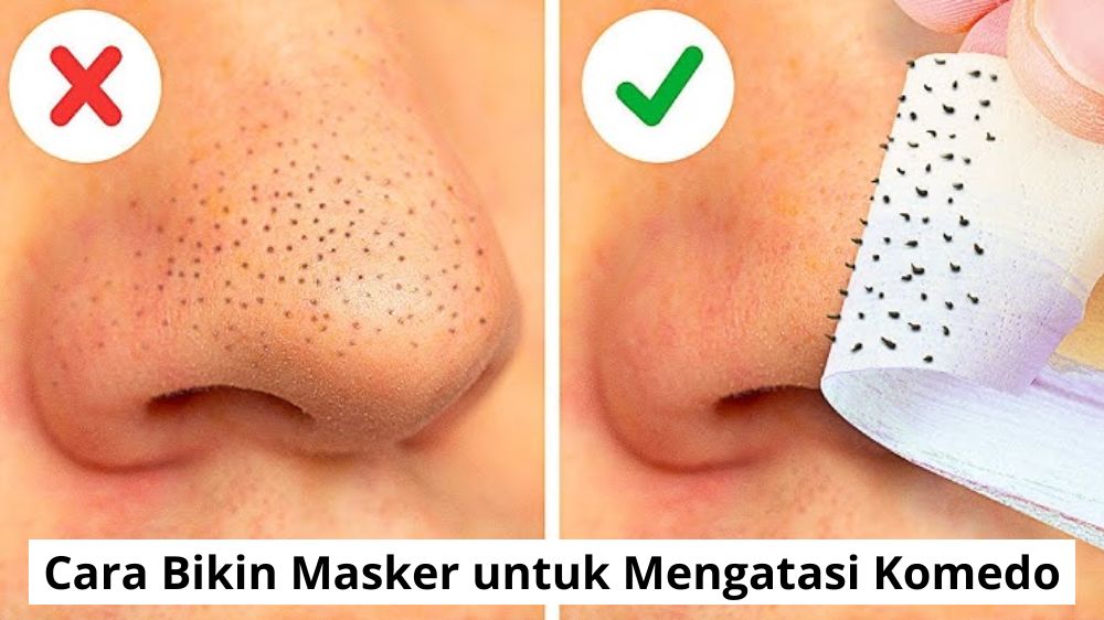 Cara Bikin Masker untuk Mengatasi Komedo dengan 2 Bahan Dapur, Bikin Wajah Jadi Mulus